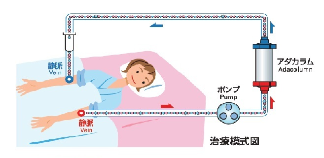 アダカラム